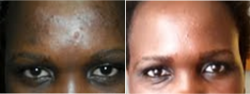 before and after - acne and dark spots