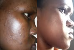 before and after - acne and dark spots