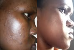 spots dark skin before acne care services