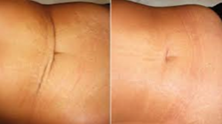 before and after - scar treatment