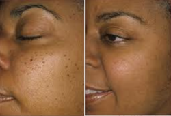 before and after - skin blemish removal