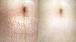 before and after - stretch mark treatment